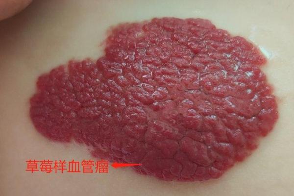 风水胎记胎记是红色的好吗危害