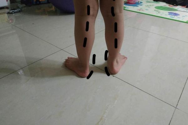 男的内八字
