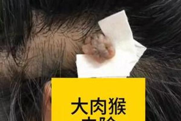 头上长瘊子好不好算命