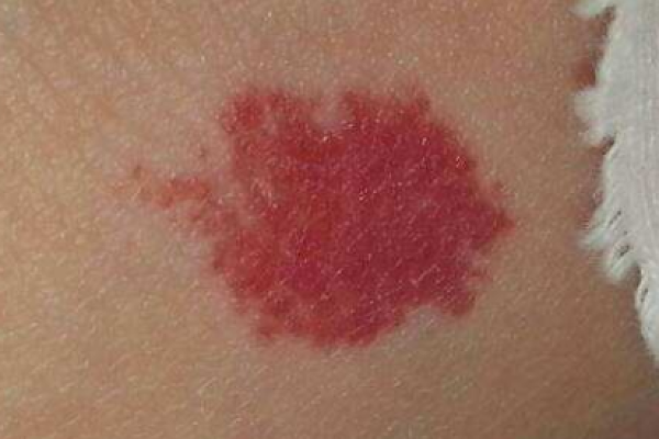 红色的胎记算命